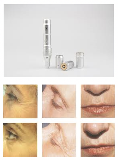 microneedling